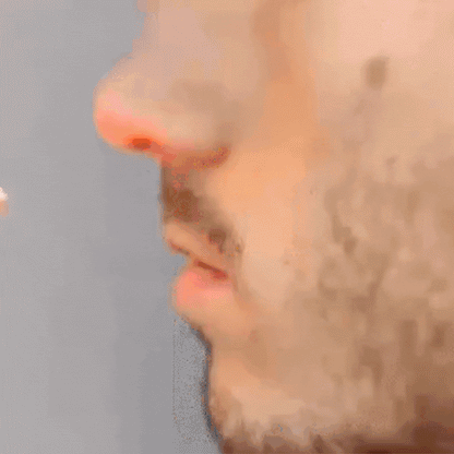 Rhinitis Laser